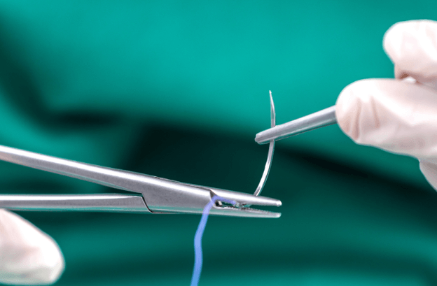 How Long Do C-Section Staples Stay In